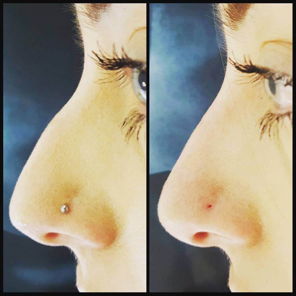 Non-Surgical Rhinoplasty