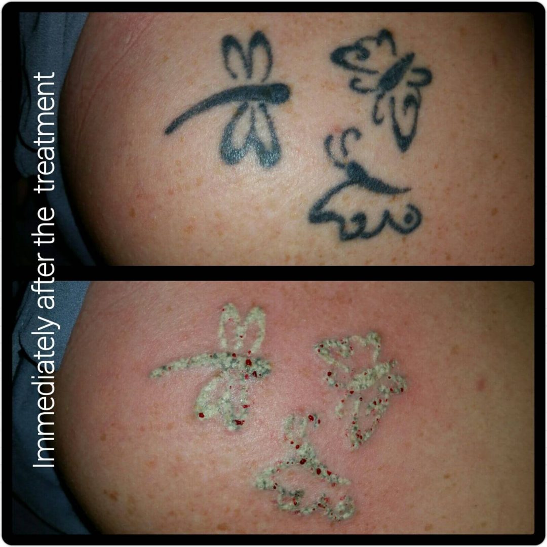 Laser Tattoo Removal - Forever Clinic | Cheltenham Aesthetics