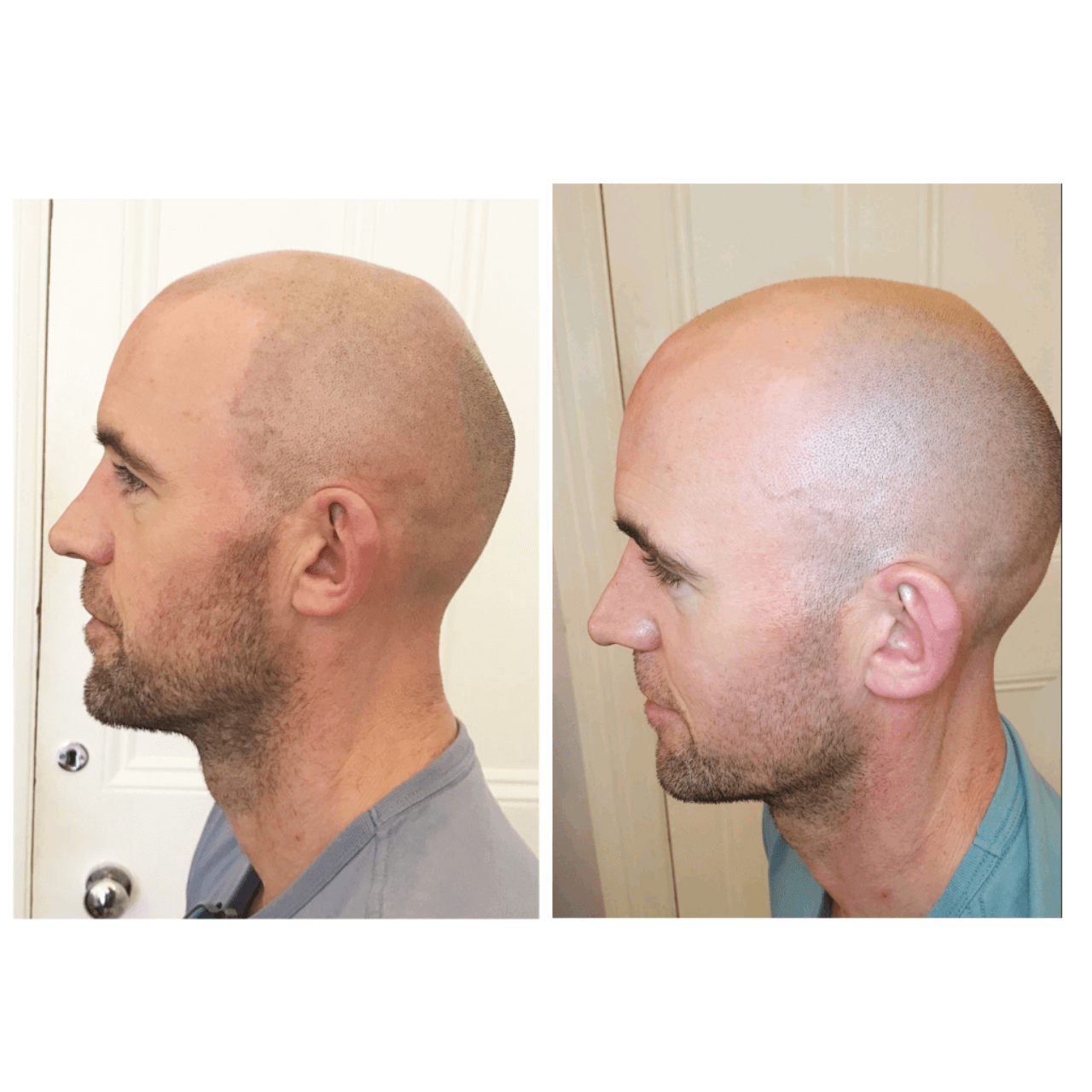 Scalp Micropigmentation - Permanent Hair Simulation Tattoo